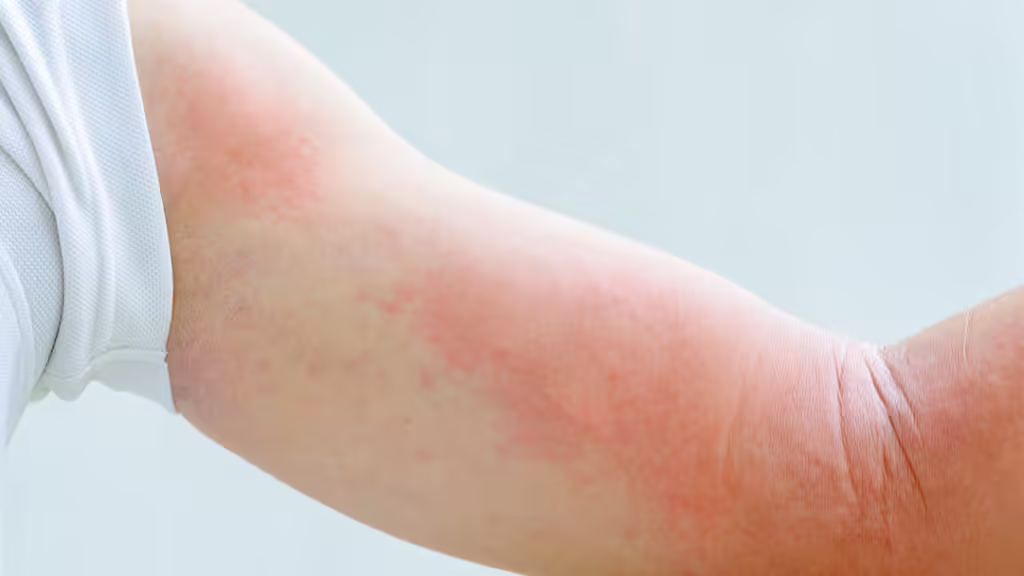 Living with erythema multiforme: Coping Strategies and Supportive Resources